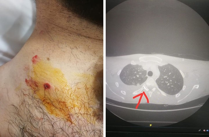 كرة خردق معدنية اخترقت رقبة أحد المتظاهرين ومزقت شريان، وثقب إحدى رئتيه، واستقرت في النخاع الشوكي.