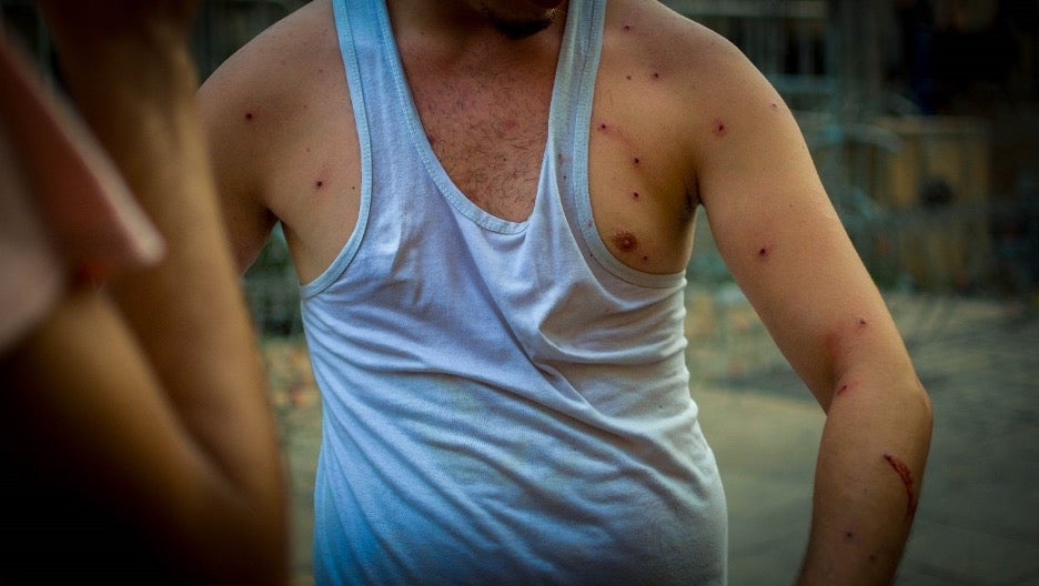 Protester injured by metal pellets. 