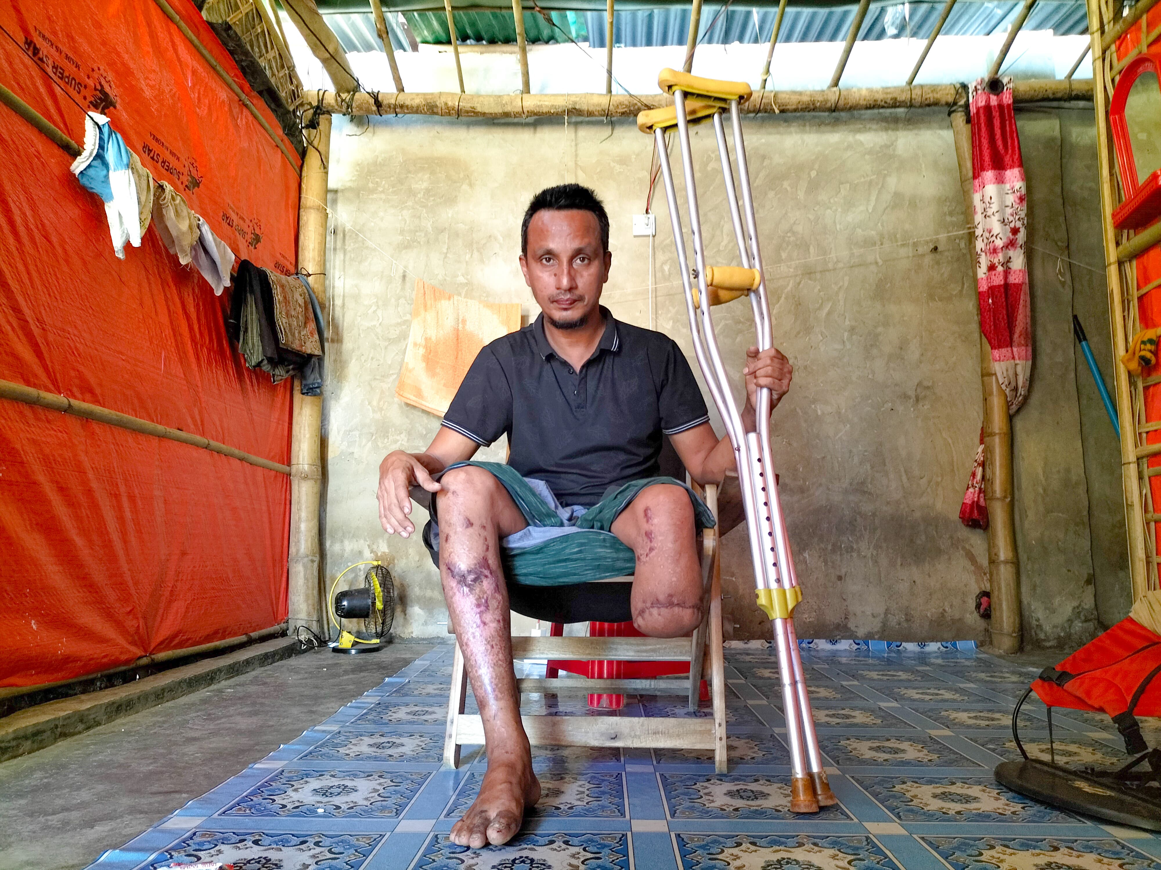 Abdullah lost his lower left leg on August 9, 2024, after stepping on an antipersonnel mine while fleeing his village in Maungdaw, Rakhine State, Myanmar