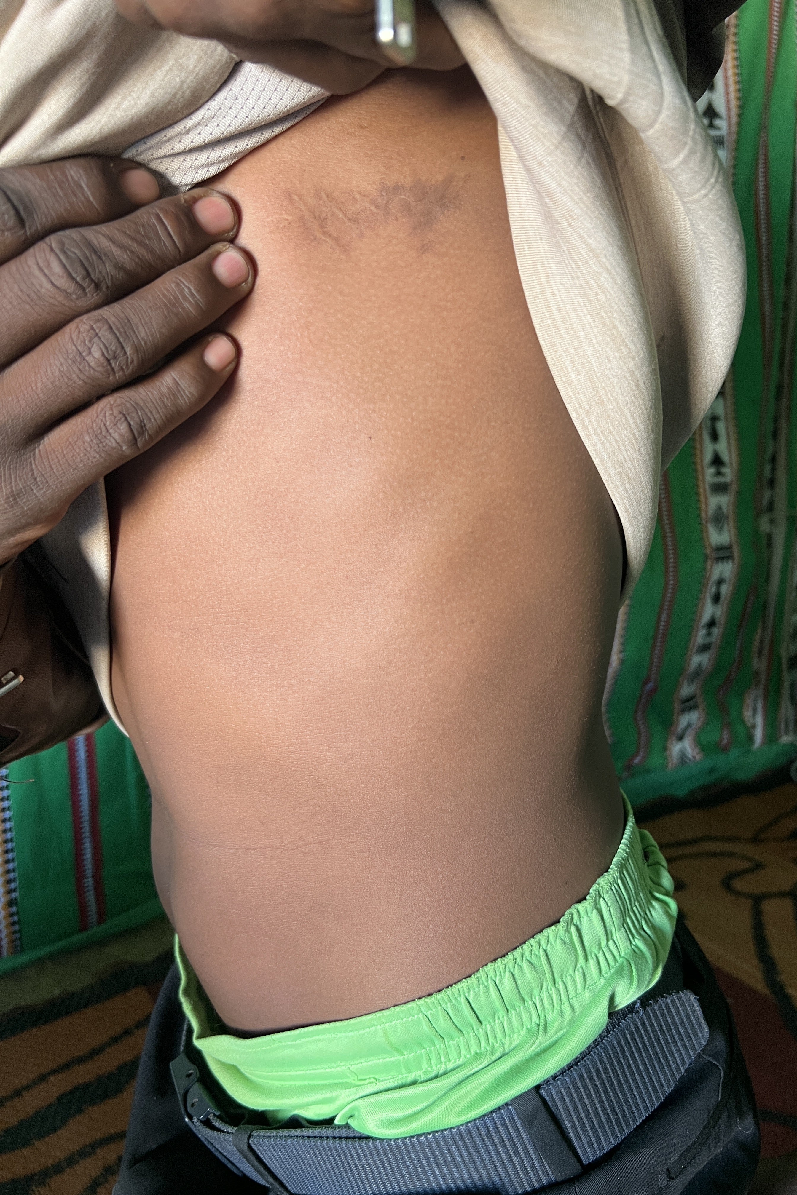 A man lifts his shirt to reveal injuries on his chest