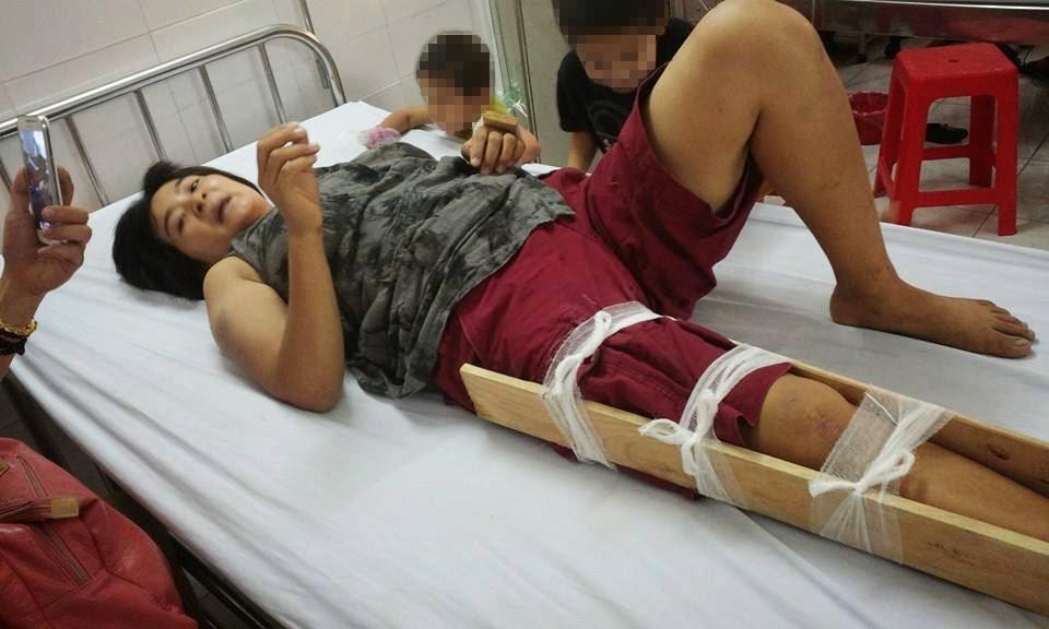 Trần Thị Nga sau khi bị hành hung ở Hà Nội ngày 25 tháng Năm năm 2014.