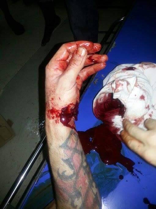 马苏德（化名）的手腕被一名巴布亚新几内亚马努斯岛的本地居民持刀划伤，2017年7月。因为澳大利亚的离岸审查政策，马苏德已被关在巴新四年。