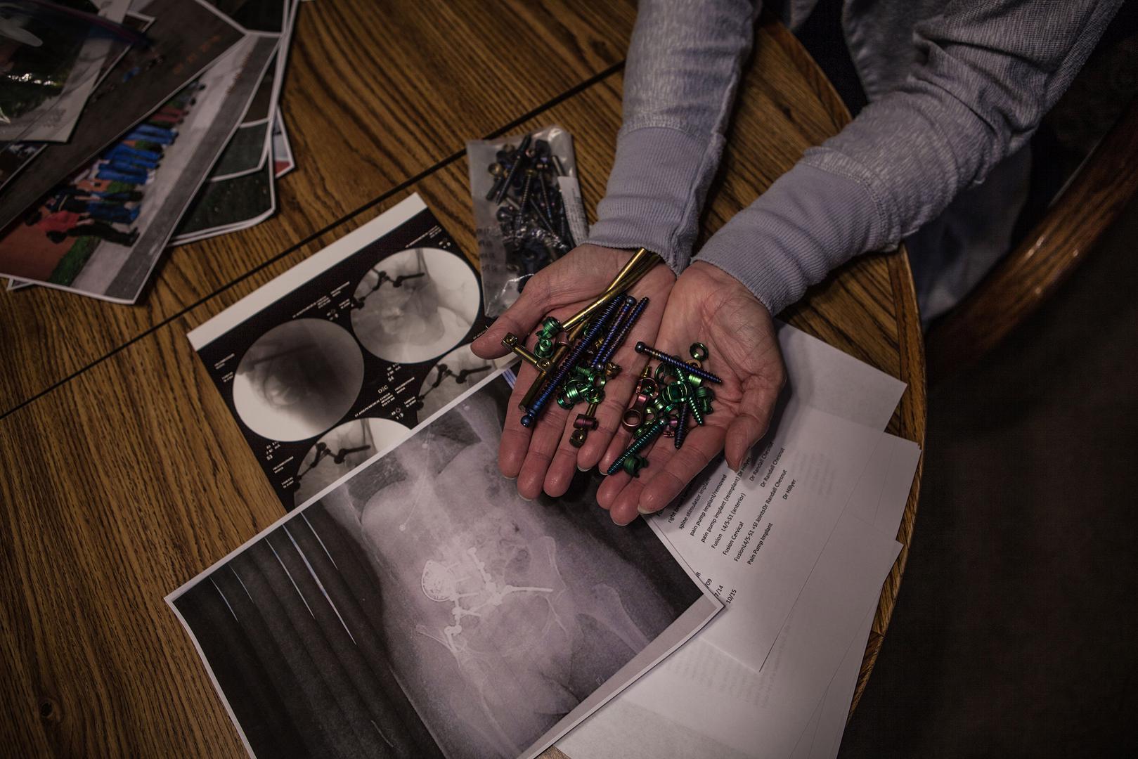 Maria Higginbotham, 57, holding screws and bolts removed from her back in a recent surgery above x-rays of her body.