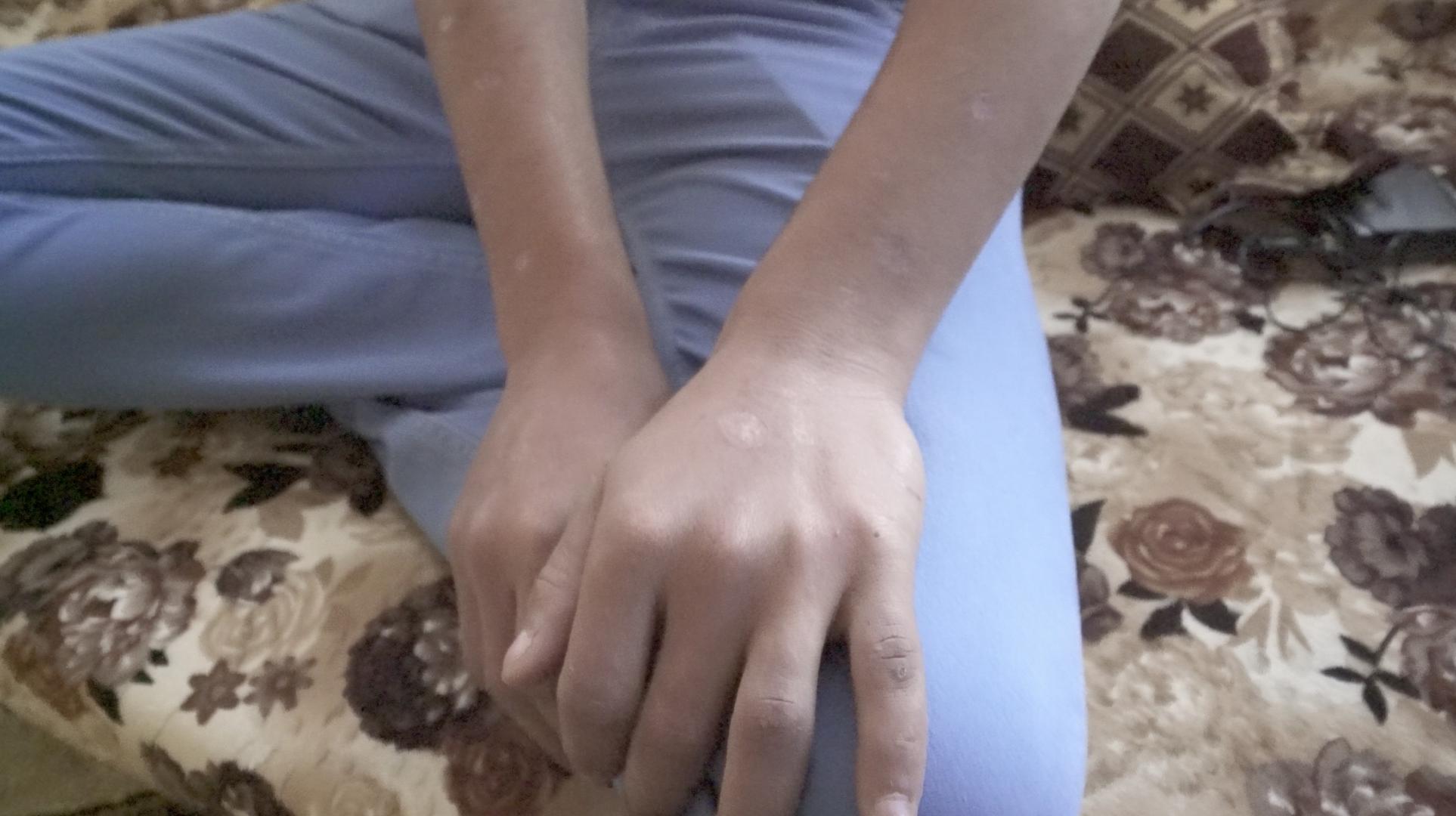Cigarette burns cover the hands and arms of 18-year-old “Karim.” Kurdish authorities held him for 13 months.  He then returned home and was rearrested by authorities under Baghdad’s control, who tortured and held him for months. © 2018 San Saravan