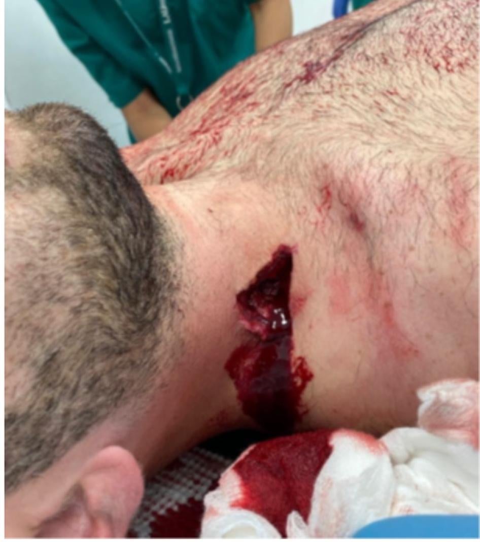 مقذوفة ذات تأثير متحرك أصابت متظاهرة في الرقبة.