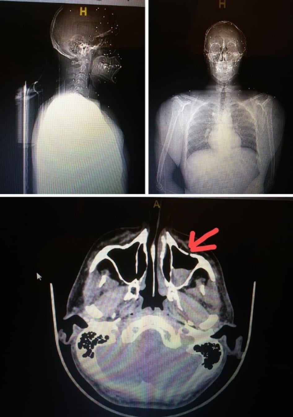 أصابت عشرات كريات الخردق هذا المتظاهر بثقب في فروة رأسه واستقرت تحت جيوبه الأنفية وفي عينه.