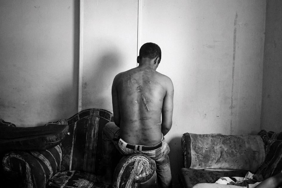 The scarred back of an Eritrean asylum seeker in Cairo who says Egyptian traffickers tortured him for ransom in Egypt’s Sinai peninsula by dripping molten plastic onto his back, May 2013.