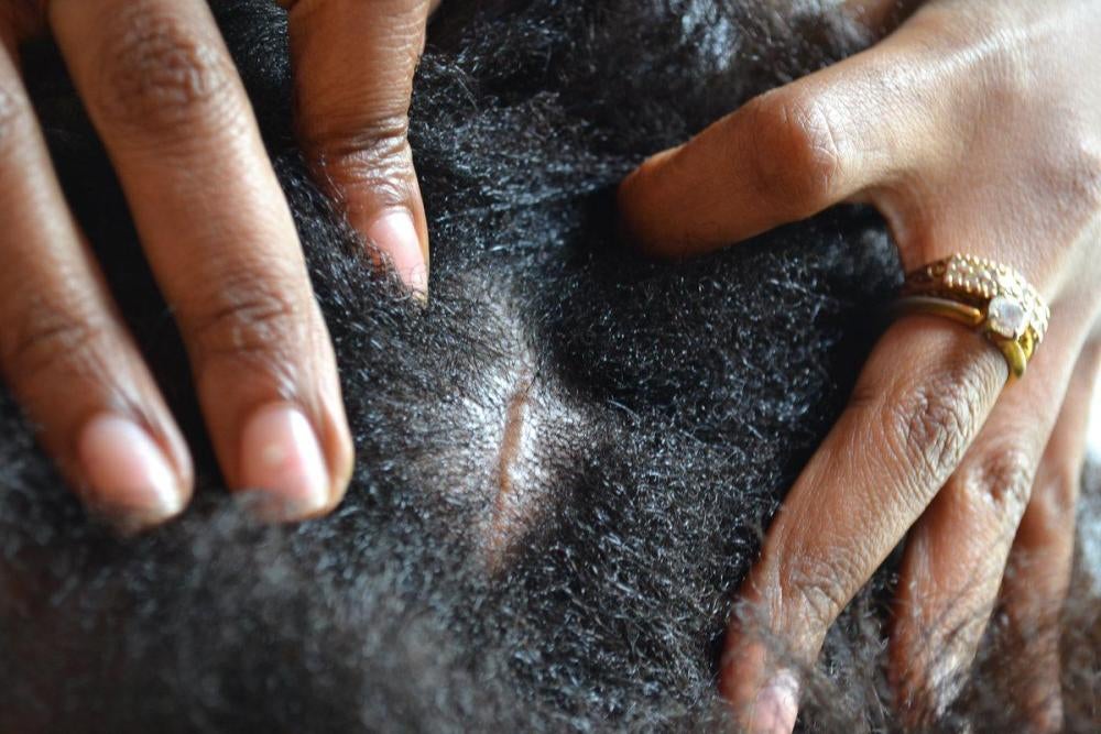 Une cicatrice sur le crâne de « Basma N. », une femme tanzanienne ayant travaillé en tant qu’employée domestique à Oman, et photographiée à Dar es Salaam, en Tanzanie. Basma a expliqué que le fils de son employeur avait allumé un ventilateur de plafond au